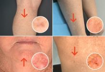 Seven signs of skin cancer you should know