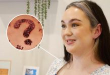 Olivia’s melanoma story