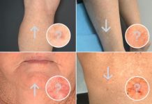 MYTH: Skin cancer only grows on sun-exposed skin